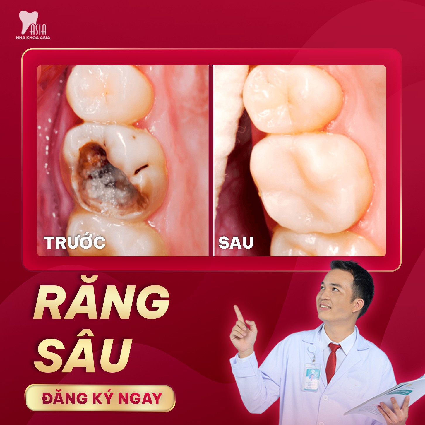 Sâu răng không chỉ liên quan đến sức khỏe nha khoa, mà còn là nỗi lo cho nhiều người.