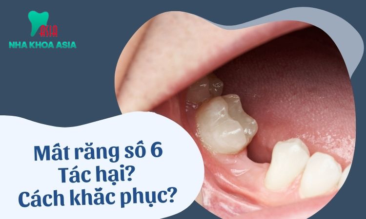 Mất răng số 6 gây ra những hậu quả gì?