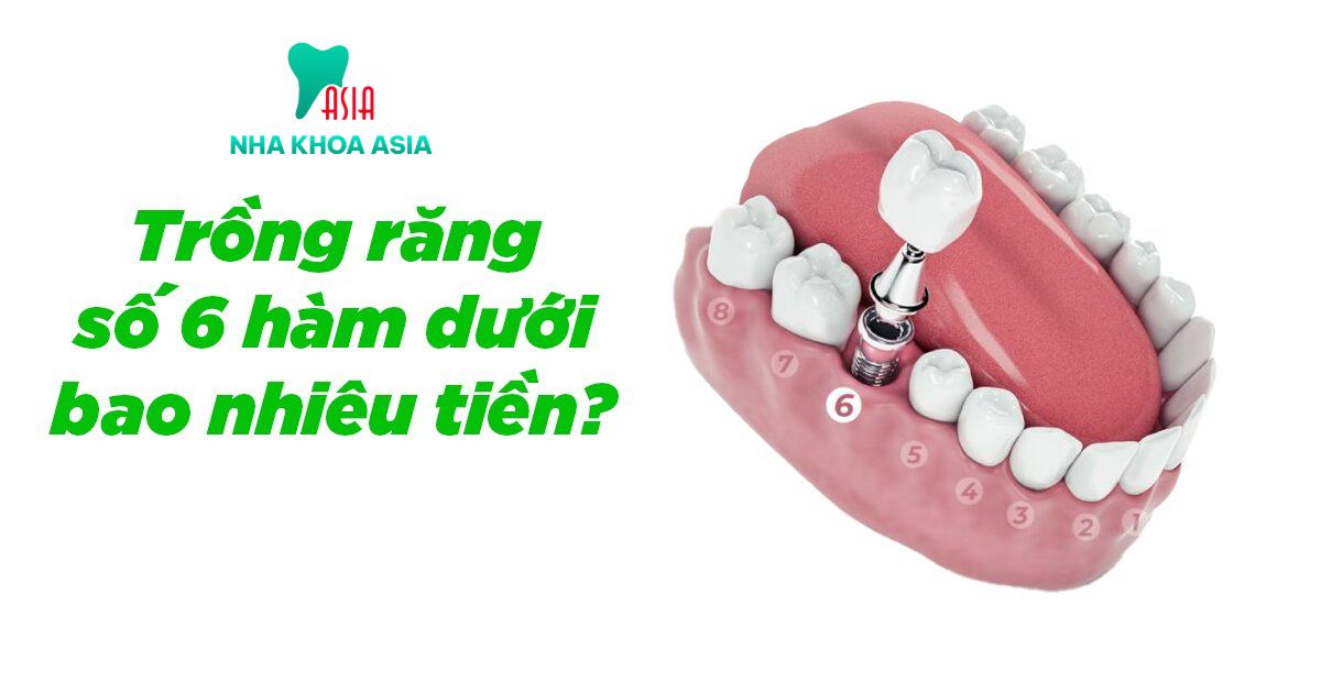 Trồng răng số 6 giá bao nhiêu tiền