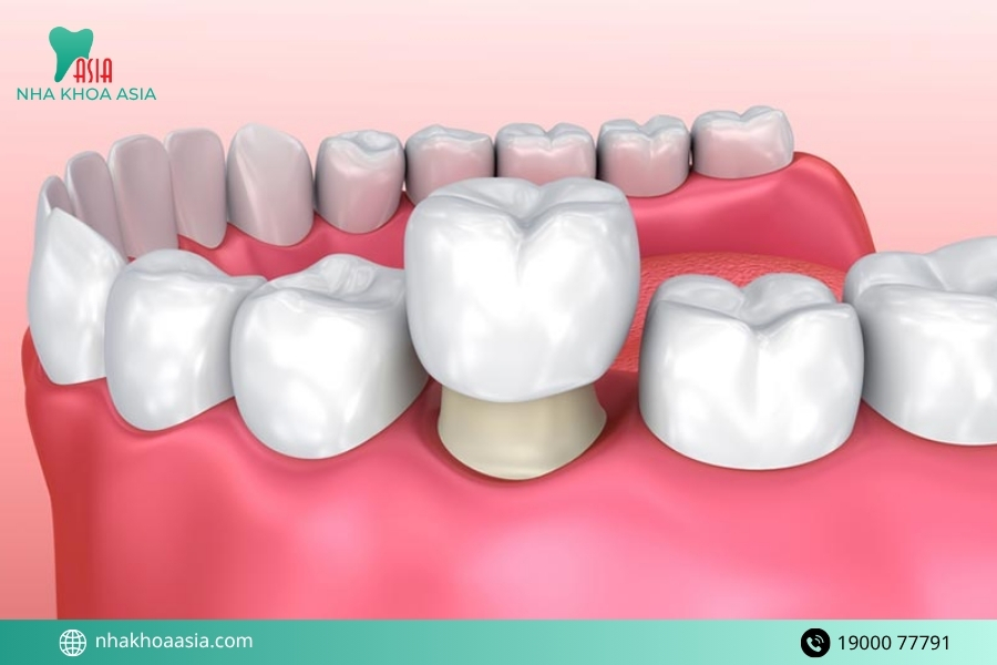 Chuyên gia mách bạn một số mẹo chăm sóc răng sứ kéo dài tuổi thọ răng