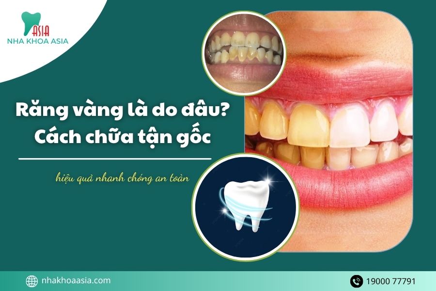 Nguyên nhân răng vàng là do đâu? 10+ Cách chữa tận gốc hiệu quả