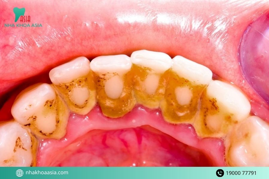 Răng vàng là do đâu? 10 nguyên nhân và cách khắc phục phù hợp