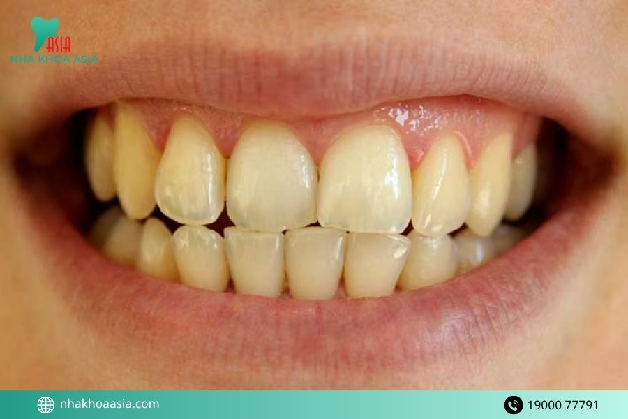 Răng vàng có phải là bệnh không?