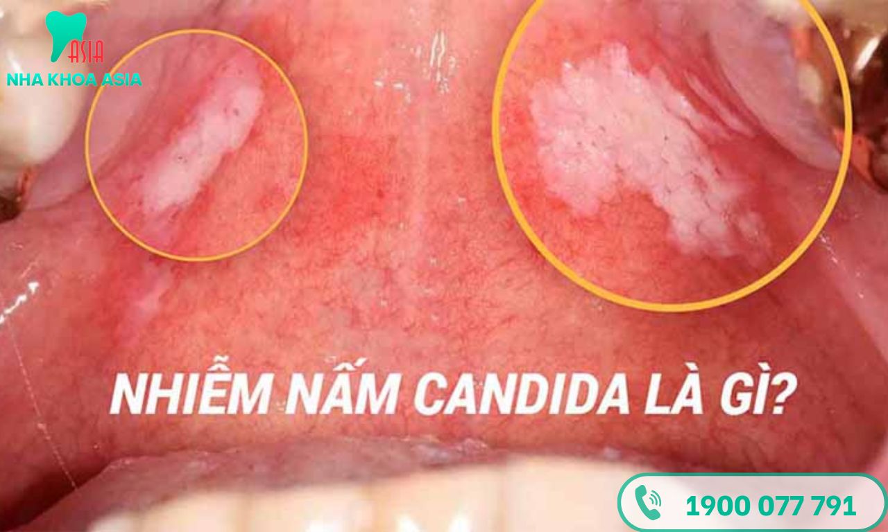 Nấm miệng Candida