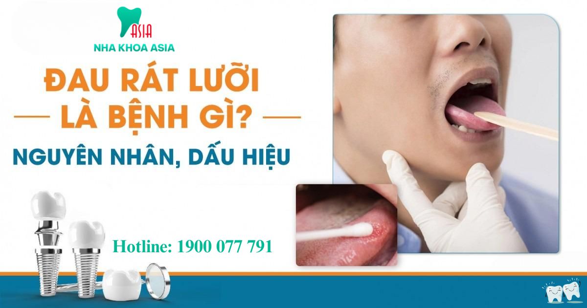 Rát lưỡi là bệnh gì?