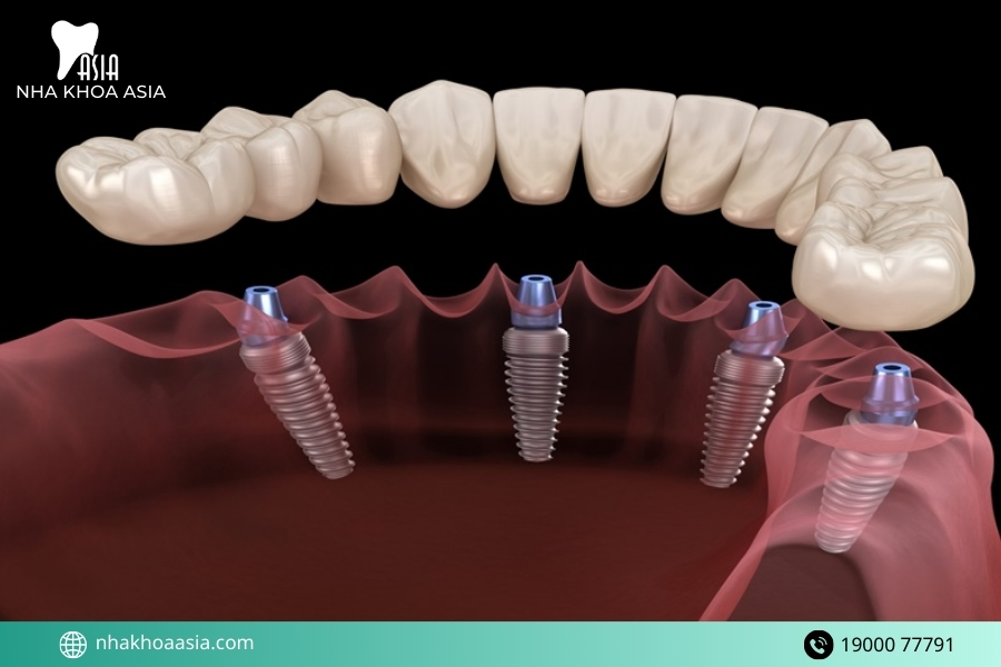 Những rủi ro khi trồng răng implant tại nơi kém chất lượng