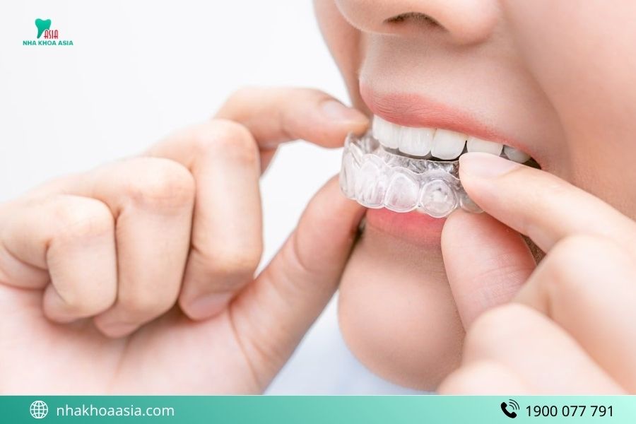 Những sai lầm nhiều người mắc phải khi niền răng trong suốt