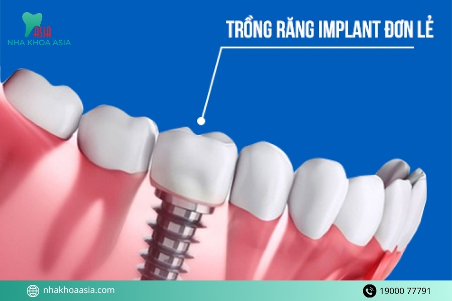 Tác dụng phụ của trồng răng implant bạn cần biết