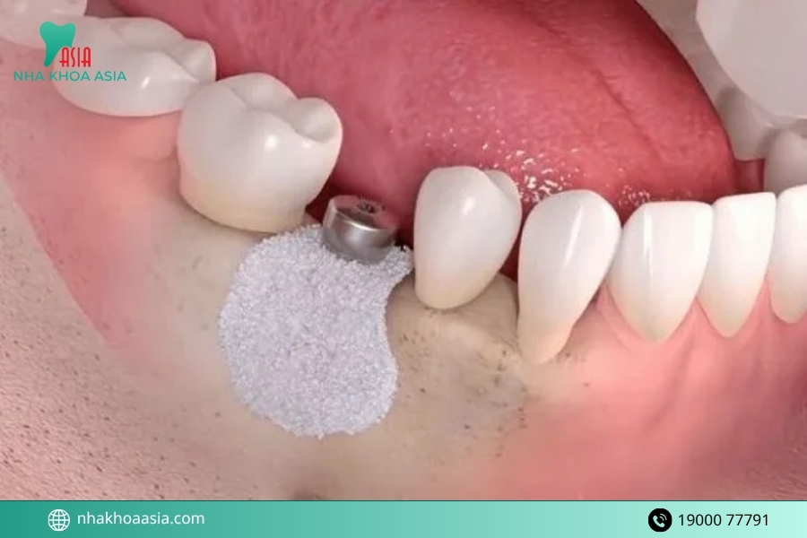 Cách phòng tránh tác dụng phụ của trồng răng implant hiệu quả