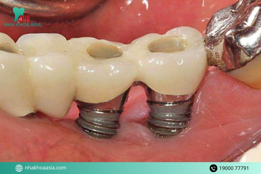 Ai có nguy cơ gặp tác dụng phụ khi trồng răng implant cao hơn