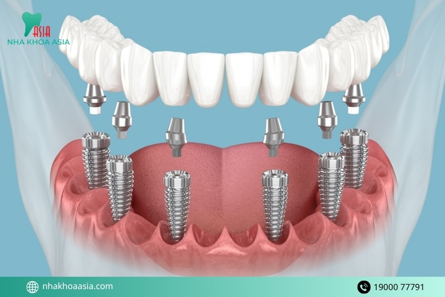 Tác dụng phụ của trồng răng implant bạn cần biết