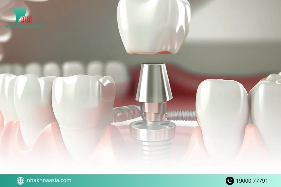 Tác dụng phụ của trồng răng implant bạn cần biết
