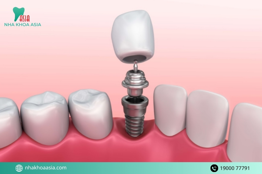 Tác dụng phụ của trồng răng implant bạn cần biết