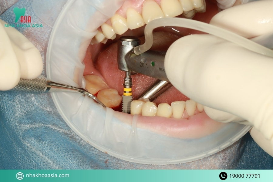 Tác dụng phụ của trồng răng implant bạn cần biết