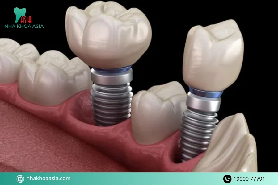 Nguyên nhân gây ra tác dụng phụ của trồng răng implant