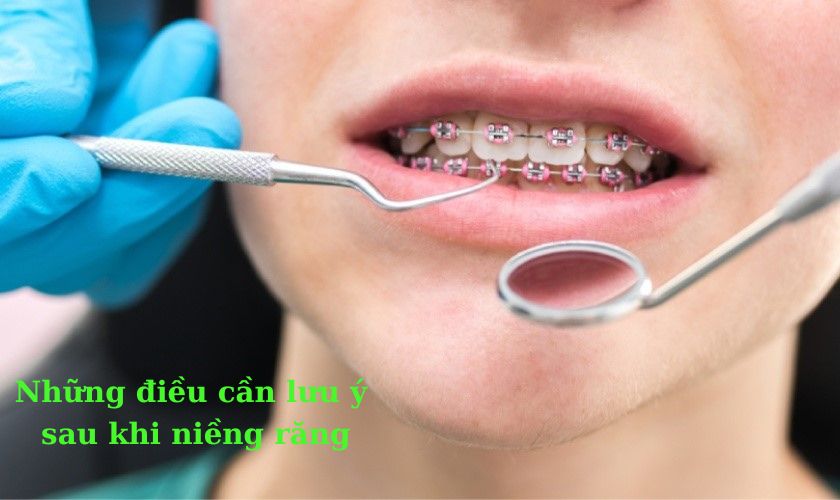 Những điều cần lưu ý sau khi niềng răng
