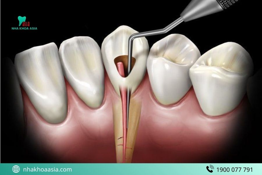 Tại sao phải lấy tủy răng lần 2