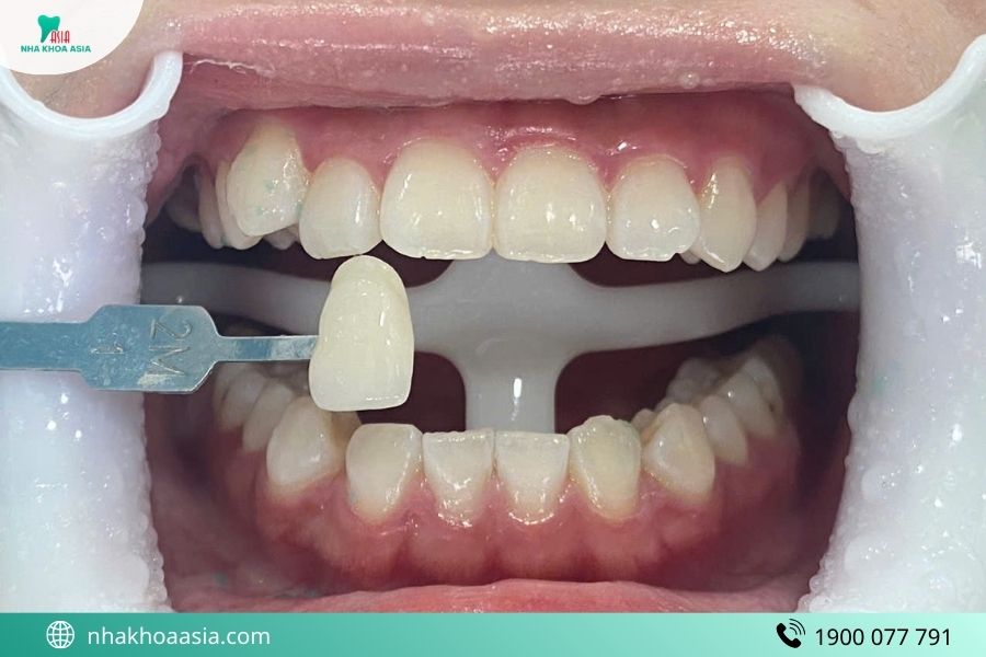 Tẩy trắng răng bao lâu thì ăn được