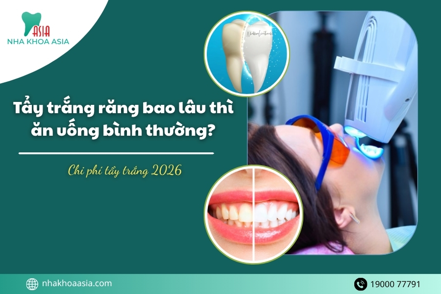 Tẩy trắng răng bao lâu thì ăn uống bình thường? Chi phí tẩy trắng năm 2026