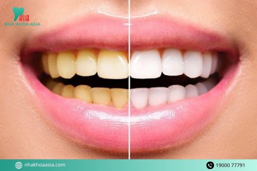Sau tẩy trắng răng nên ăn gì để giữ màu trắng lâu?