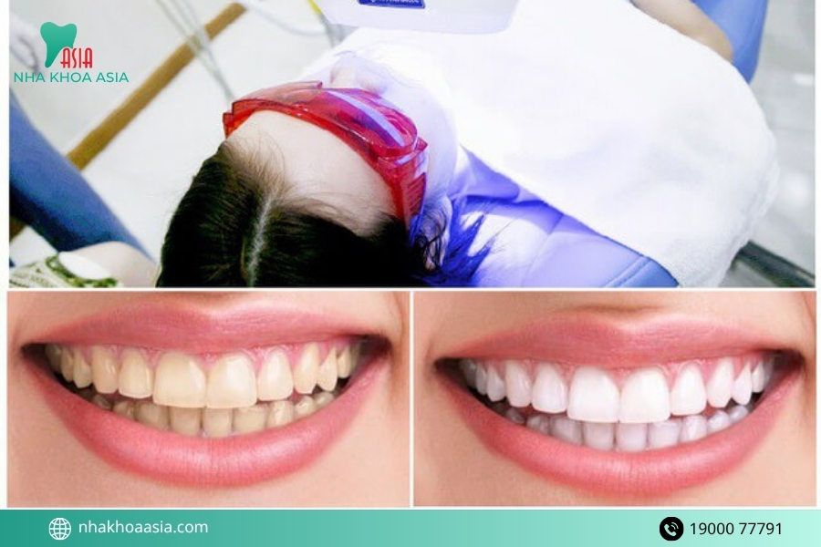 Vì sao cần kiêng ăn sau khi tẩy trắng răng?