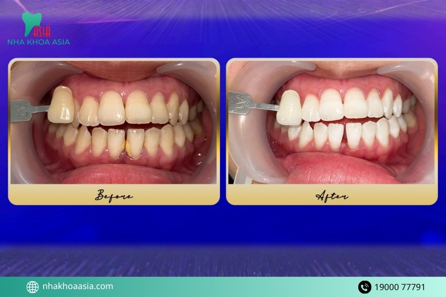 Timeline ăn uống sau tẩy trắng răng chi tiết từng giai đoạn