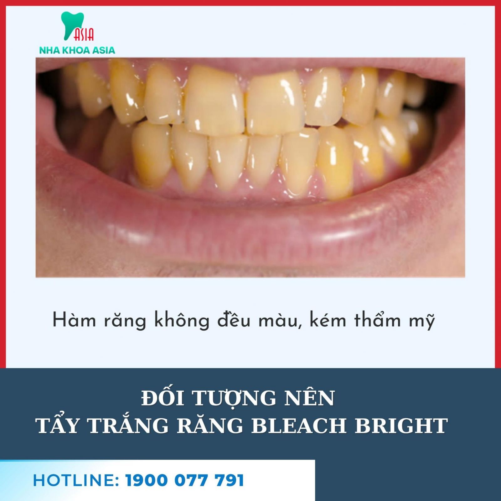 Đối tượng cần tẩy trắng răng Bleach Bright? 