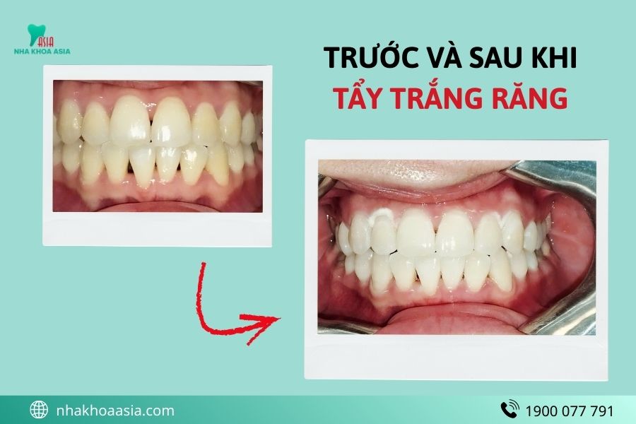 Tẩy trắng răng có làm răng yếu đi không?