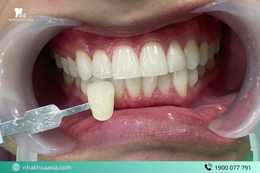 Tẩy trắng răng là gì? Có làm răng yếu đi không?