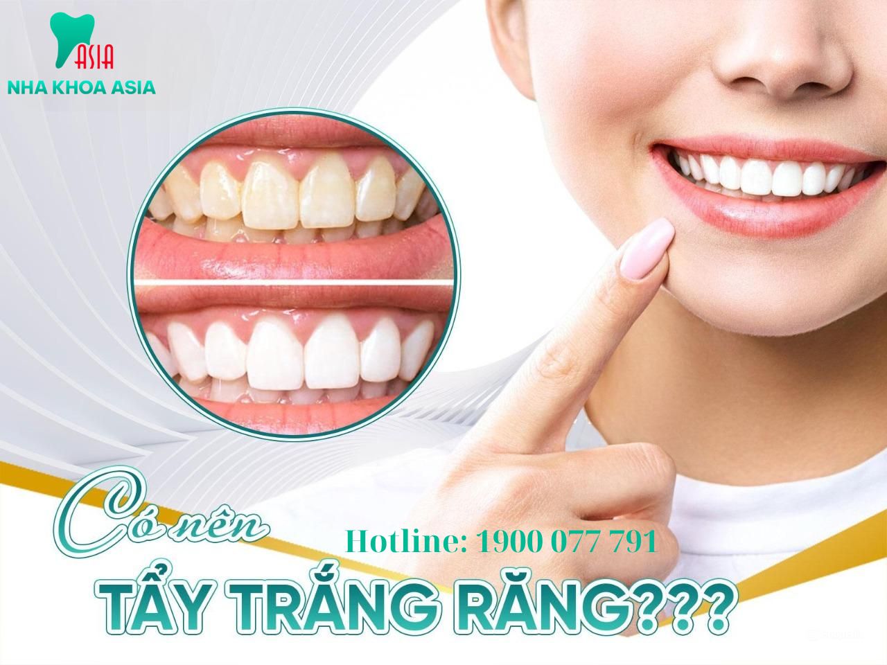 Có nên tẩy trăng răng tại nhà không?