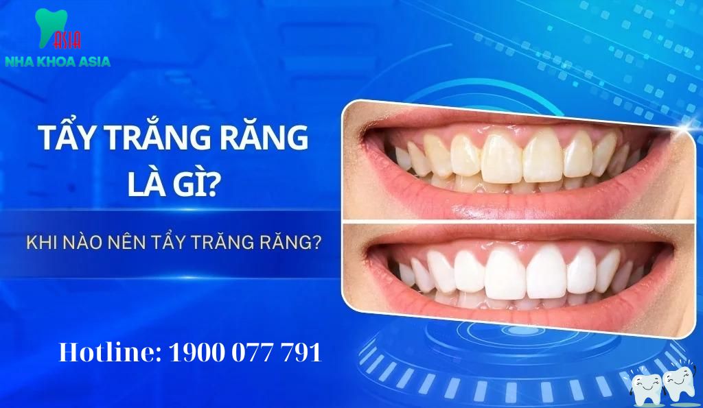 Tẩy trắng răng là gì?