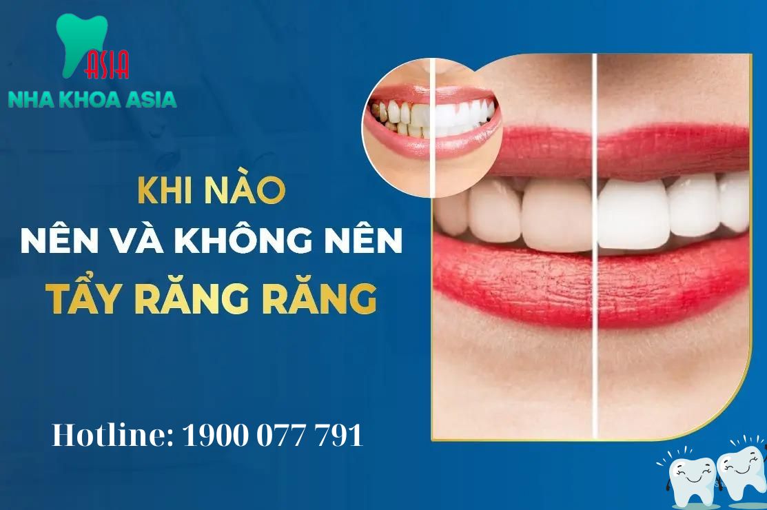 Thời điểm thích hợp tẩy trắng răng và không nên tẩy trắng răng