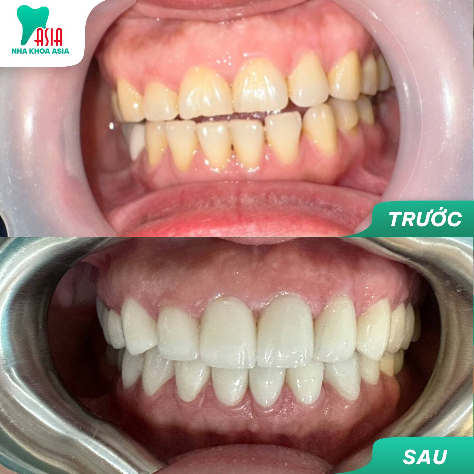 Laser Whitening là phương pháp tẩy trắng răng hiệu quả, hiện đại bậc nhất