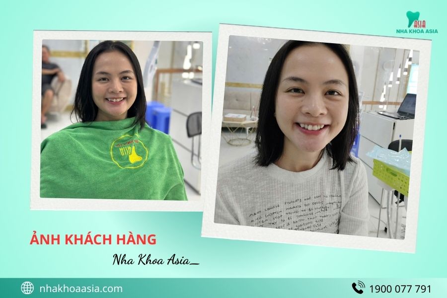Tẩy trắng răng ở đâu an toàn Tp.HCM