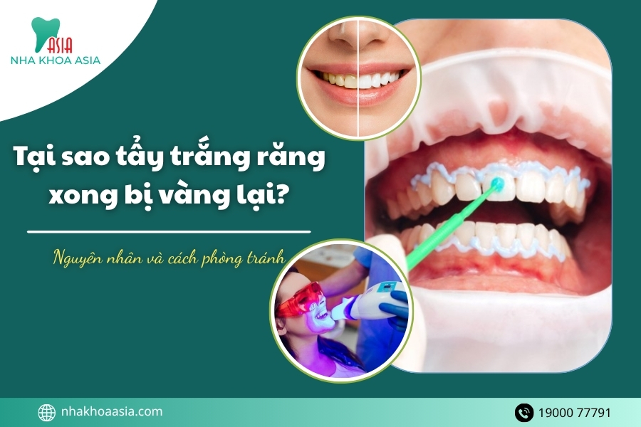 Tẩy trắng răng xong bao lâu thì răng sẽ vàng lại?