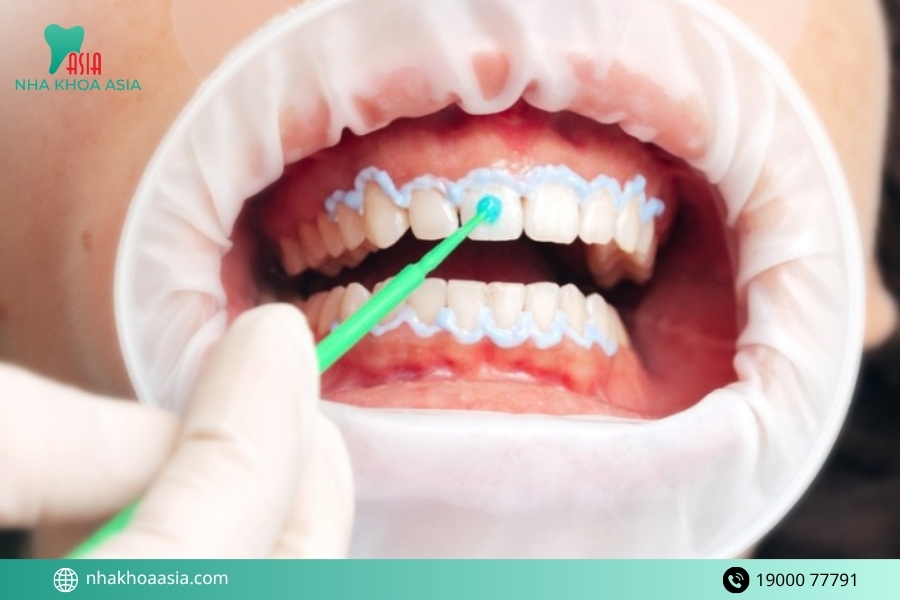 Những trường hợp dễ bị vàng lại nhanh nhất