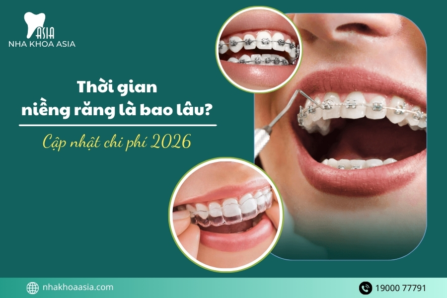 Thời gian niềng răng là bao lâu? Cập nhật chi phí niềng răng trọn gói 2026