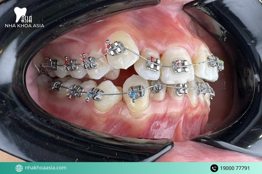 Nên niềng răng trong độ tuổi nào là phù hợp nhất?