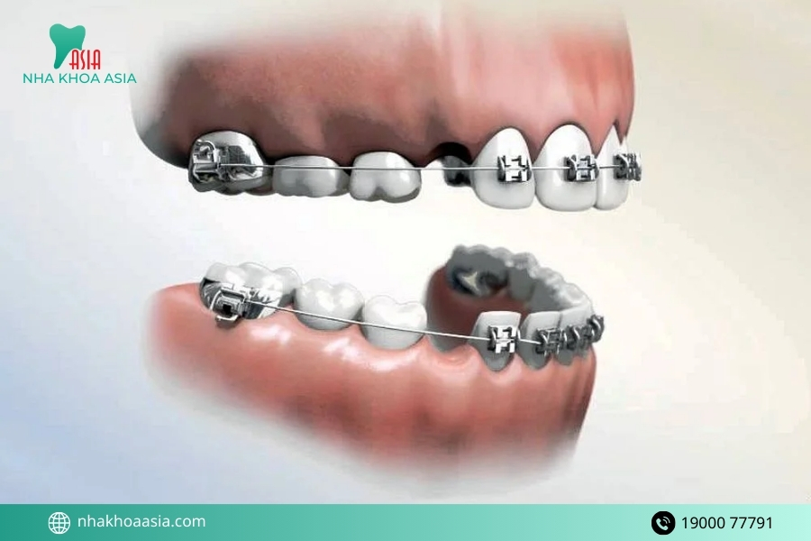 Những trường hợp không nên tác động răng lợi hoặc niềng răng 