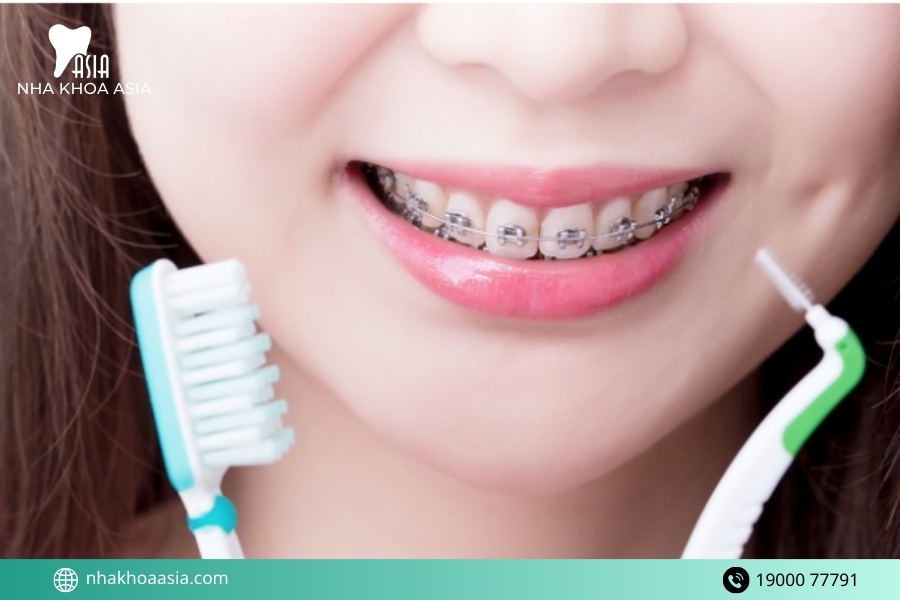 Chuyên gia mách bạn cách vệ sinh răng miệng sau niềng răng đúng cách 