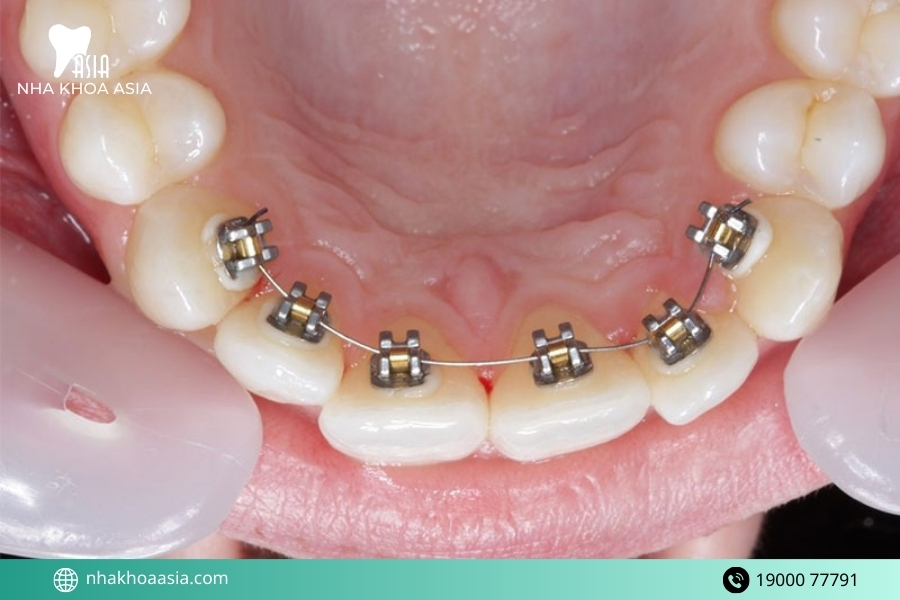 Các loại mắc cài niềng răng phổ biến hiện nay