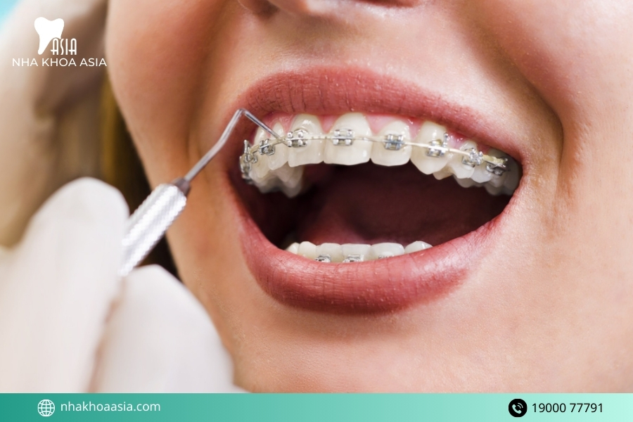 Những trường hợp nên niềng răng từ sớm 