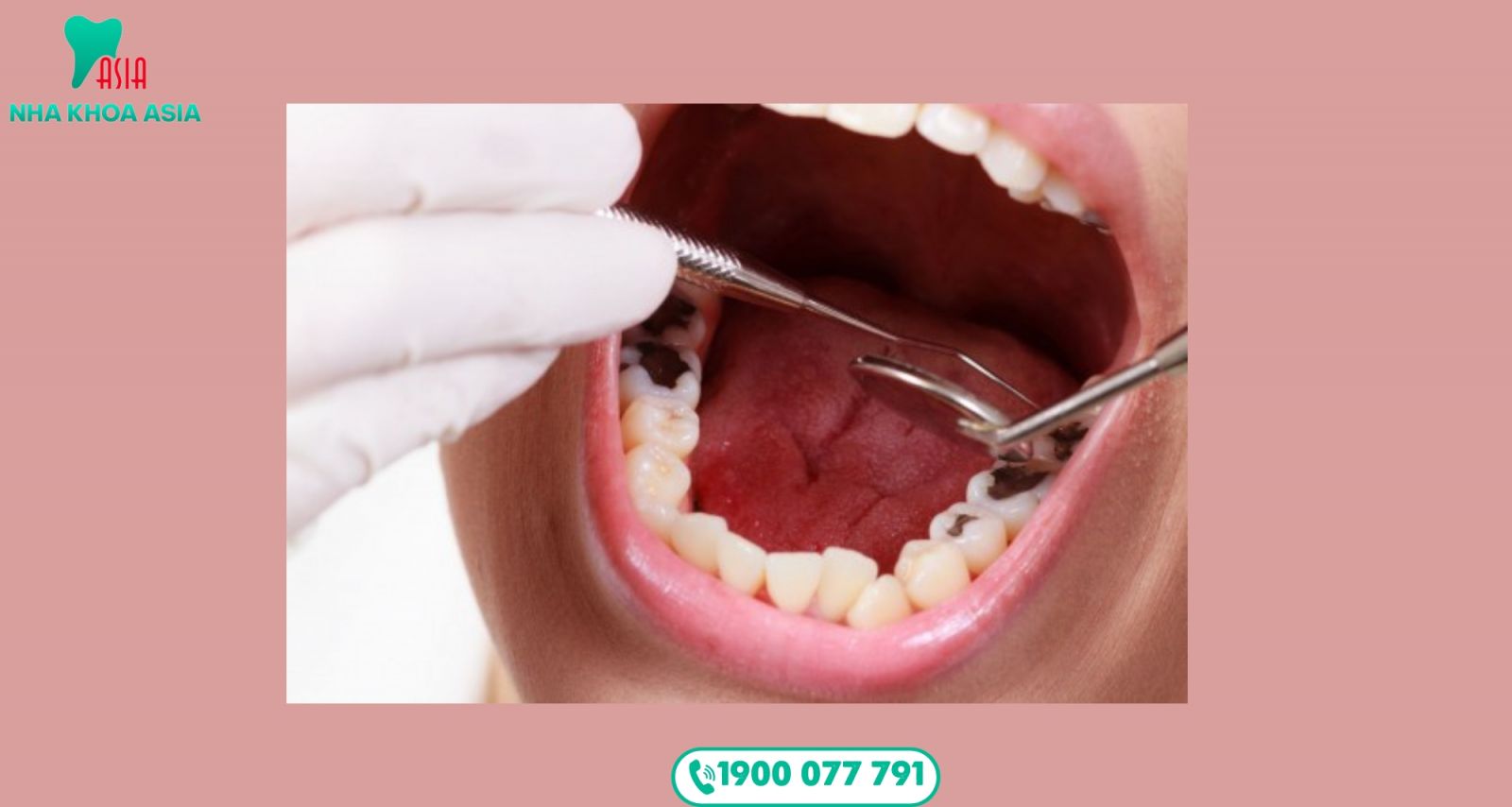 Số lượng răng sâu và hư càng nhiều, thời gian trám răng sẽ kéo dài