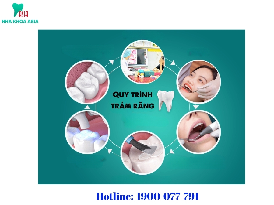 Quy trình trám răng bao gồm các bước điều trị để phục hồi răng bị tổn thương, tùy thuộc vào tình trạng của sức khỏe răng miệng