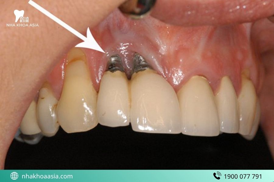 Tiêu xương quanh trụ Implant