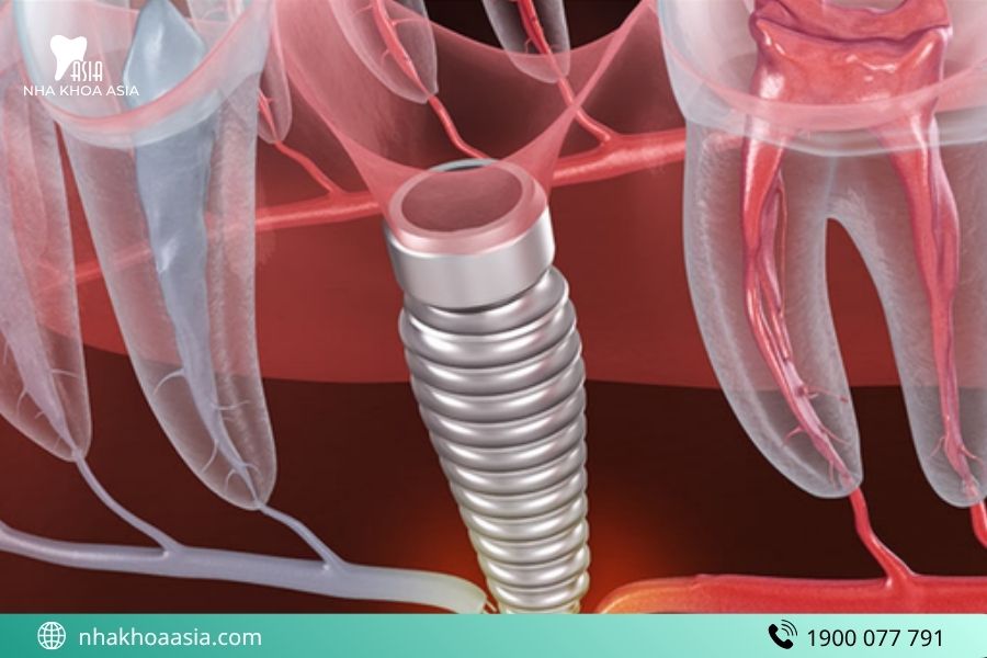Tổn thương dây thần kinh và mạch máu sau trồng Implant