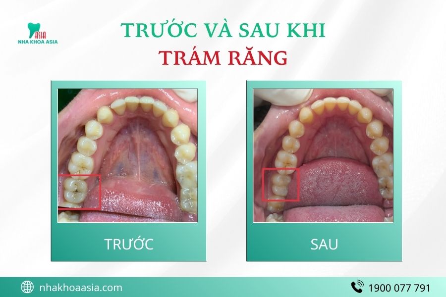 Trám lại răng có đau không?