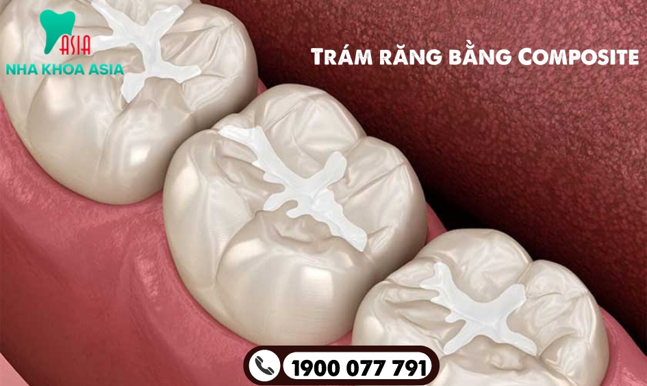 Trám răng bằng Composite là phương pháp sử dụng vật liệu nhựa để phục hồi răng bị sâu, nứt và mẻ