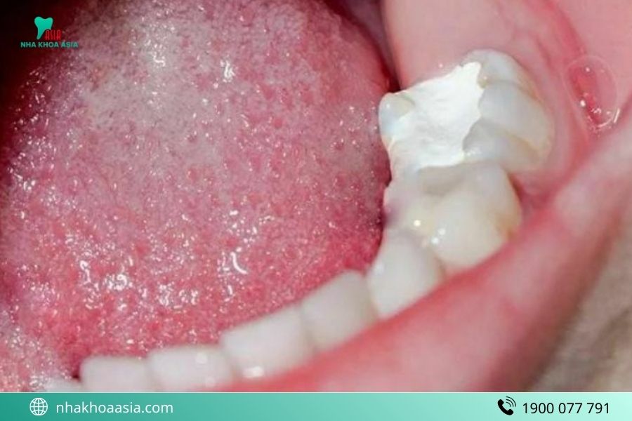 Trám răng bao lâu thì trám lại?