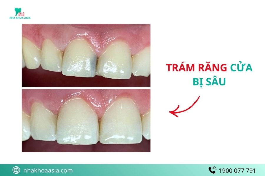Trám răng giá rẻ Tp.HCM